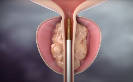 홀뮴 레이저 모세 시스템 연혁 이미지