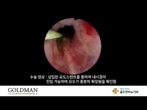 요도스텐트 삽입 후 내시경 진입, 요도 확장 확인 (골드만비뇨기과)