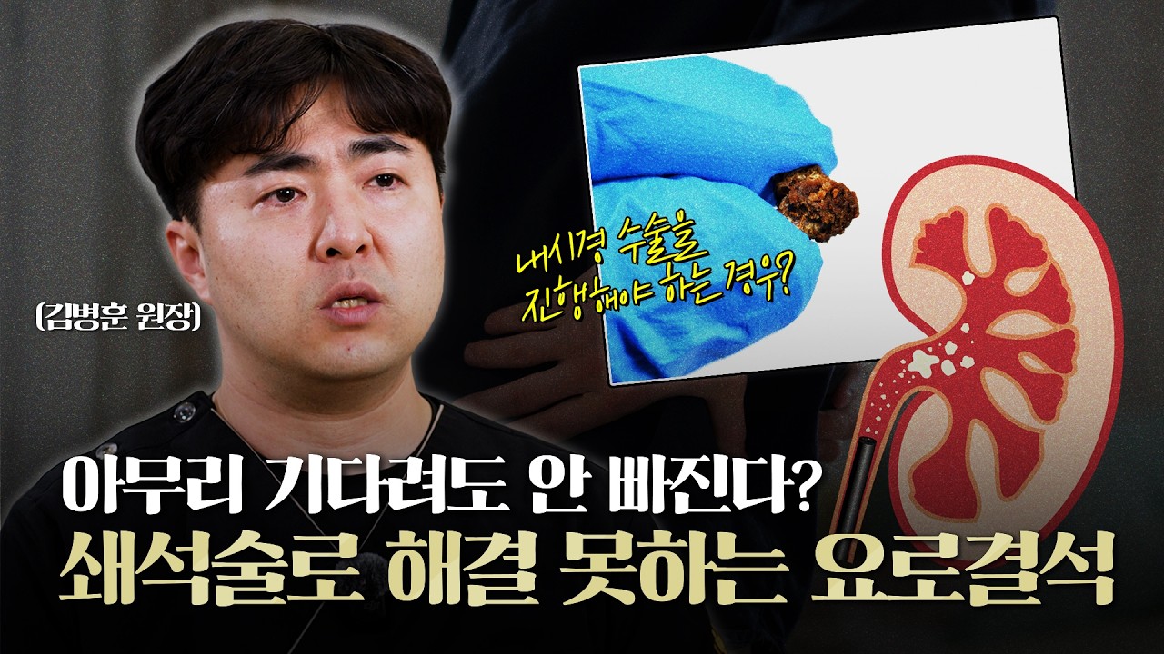 아무리 기다려도 안 빠진다? 쇄석술로 해결 못하는 요로결석이 있다고?_이미지