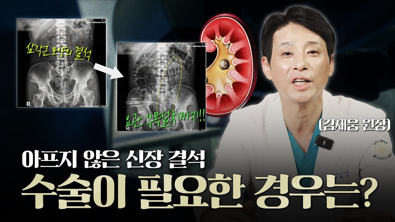 아프지 않은 신장결석인데..수술이 필요한 경우가 있다구요?_이미지