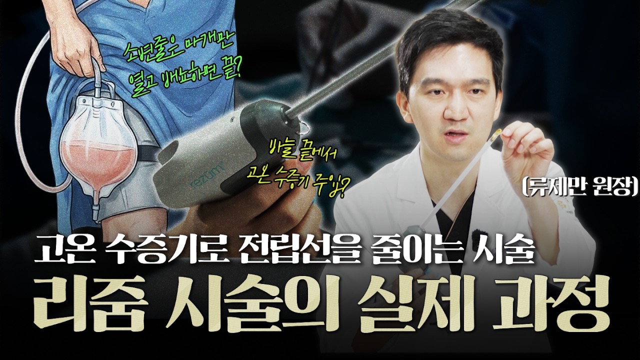 고온 수증기로 전립선 비대 부위를 줄여주는 전립선비대증 수술, 리줌의 실제 과정_이미지