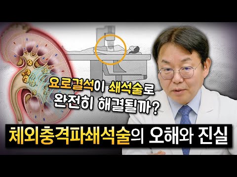 극한의 고통 요로결석, 쇄석술로 완전히 제거할 수 있을까요?_이미지
