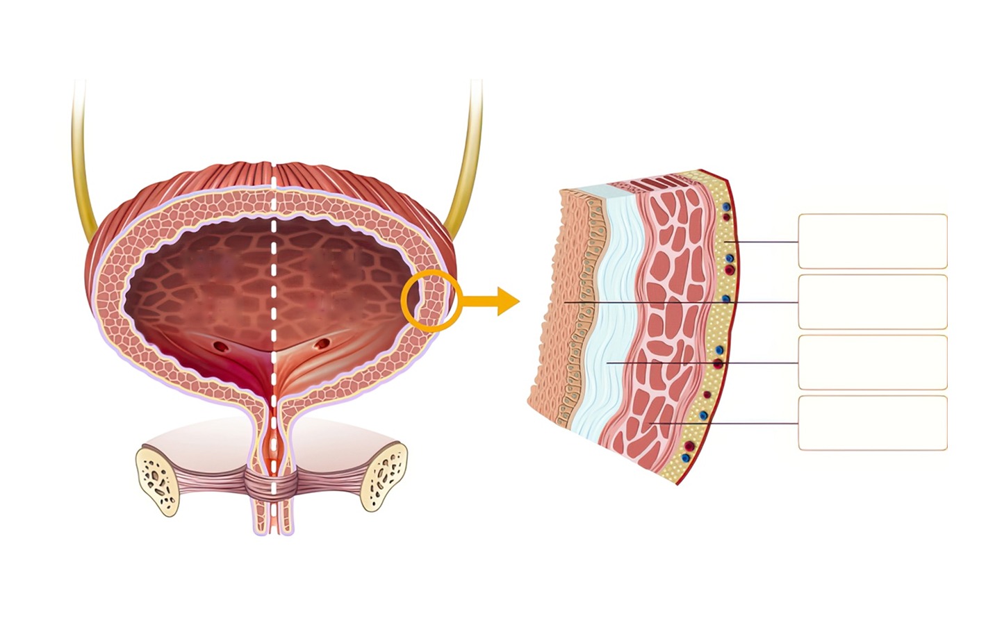 Illustration comparing a normal and an inflamed bladder