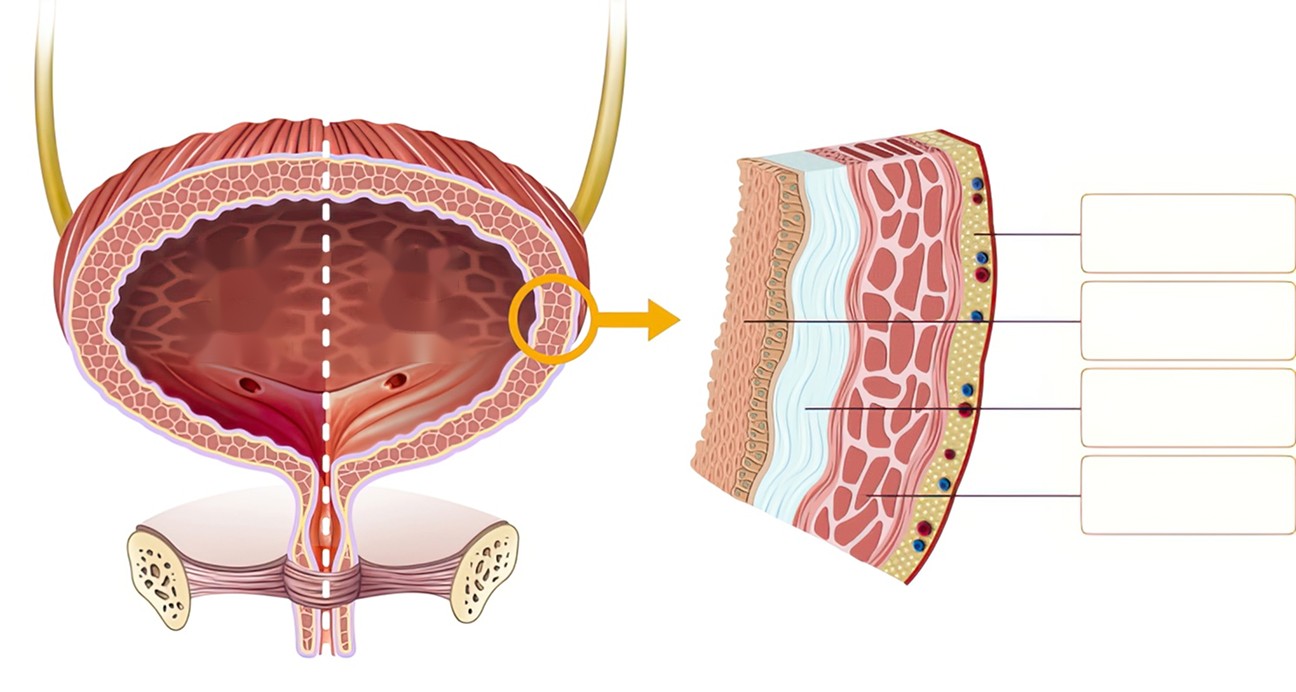 Illustration comparing a normal and an inflamed bladder