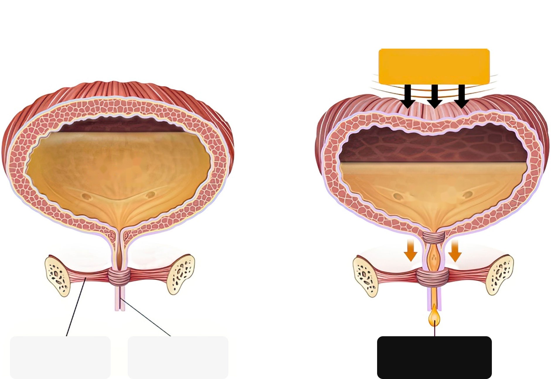 Normal function vs. stress urinary incontinence, where urine leaks under increased abdominal pressure