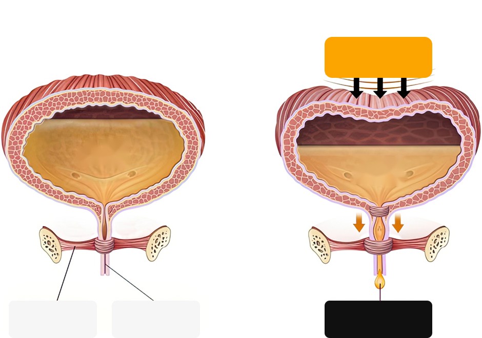 Normal function vs. stress urinary incontinence, where urine leaks under increased abdominal pressure