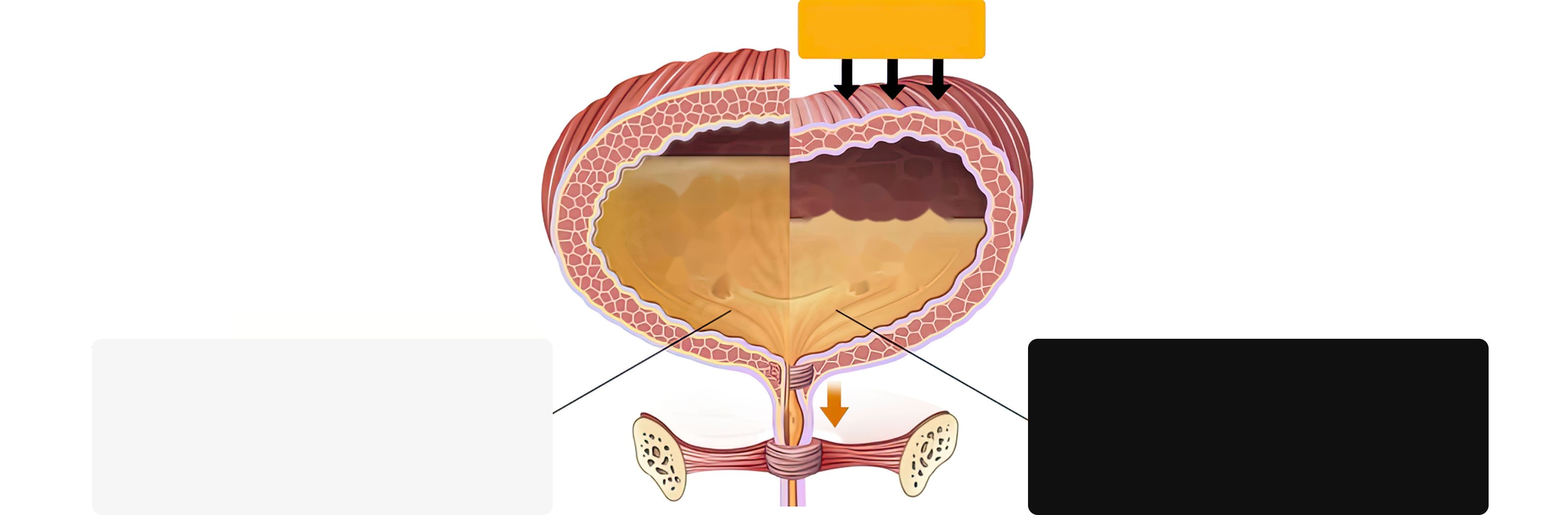Normal bladder – no discomfort until full (about 400–500 ml) / Overactive bladder – the detrusor muscle contracts even with little urine, making it hard to hold