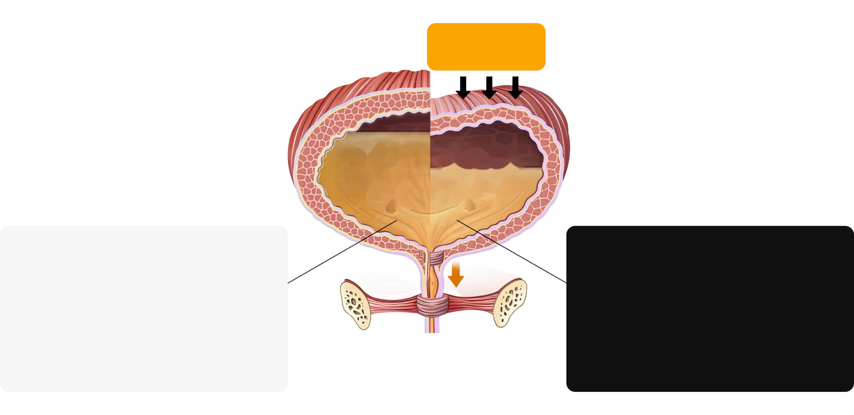 Normal bladder – no discomfort until full (about 400–500 ml) / Overactive bladder – the detrusor muscle contracts even with little urine, making it hard to hold