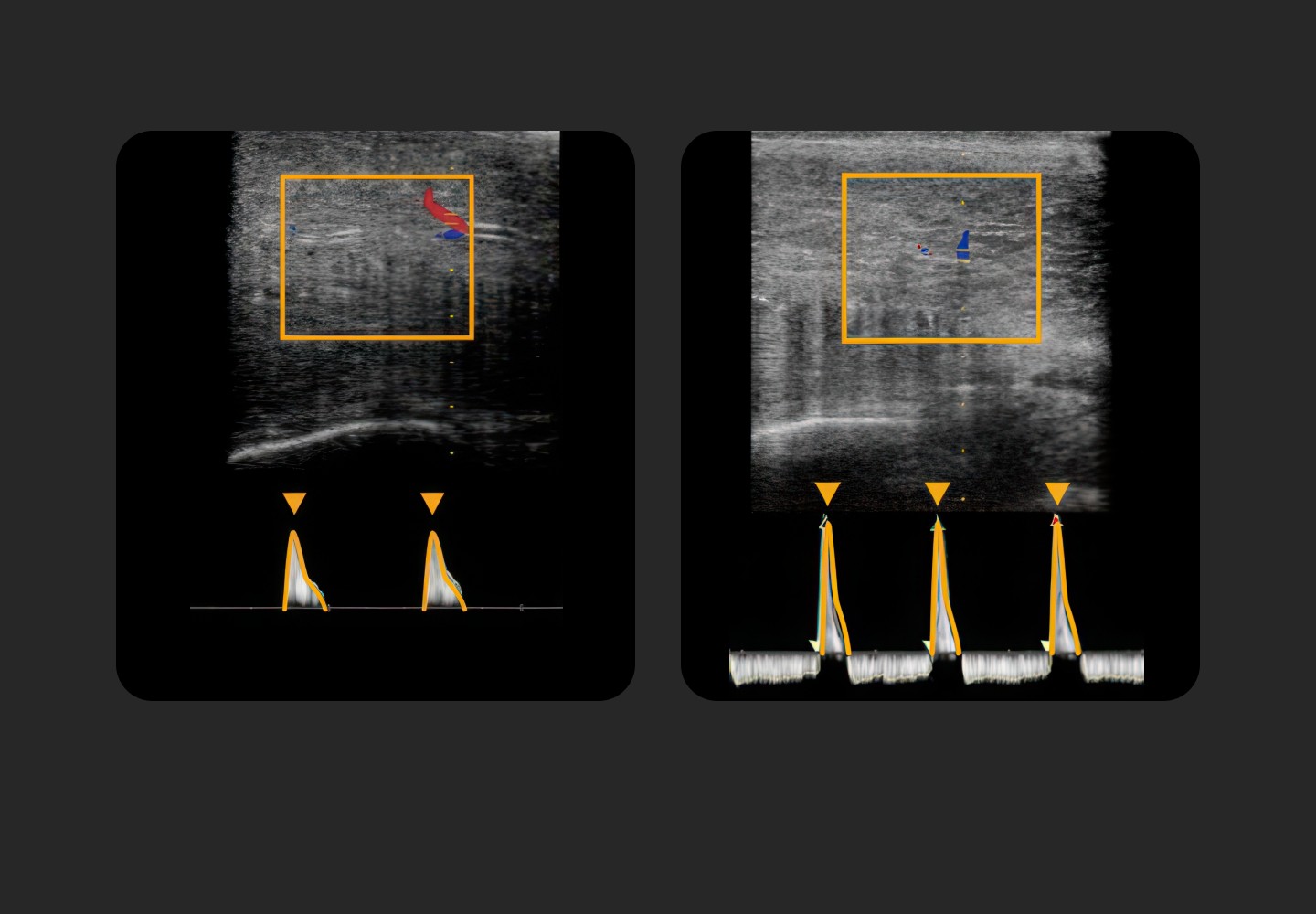 Penile duplex Doppler ultrasound examination screen