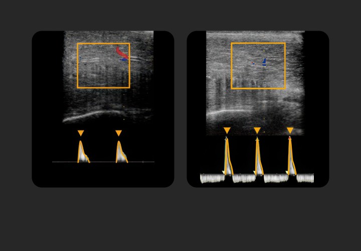 Penile duplex Doppler ultrasound examination screen