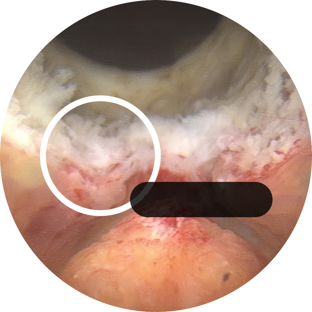 Hood Sparing surgery / more tissue around the verumontanum preserved
