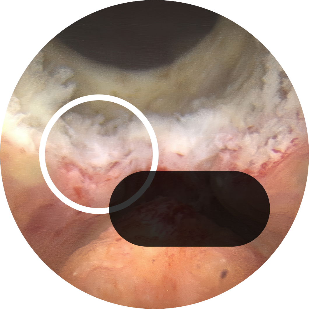 Hood Sparing surgery / more tissue around the verumontanum preserved