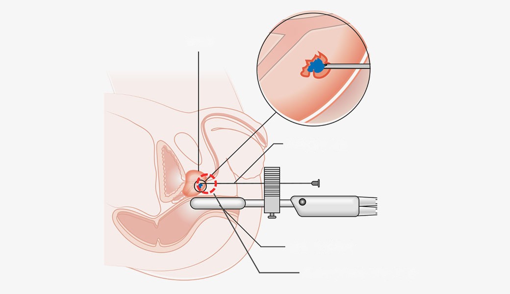 Transperineal access screen