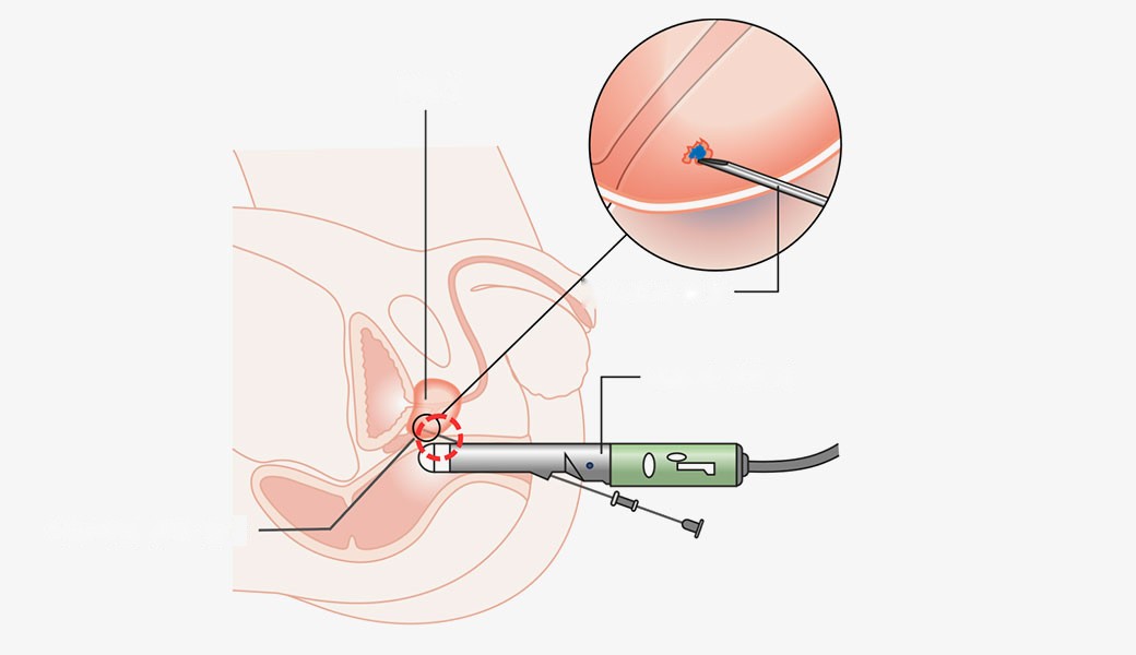 Academic and press materials on BPH surgery