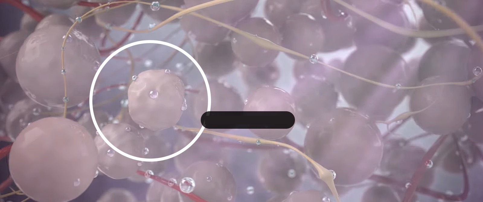 Enlarged tissue being necrosed by steam