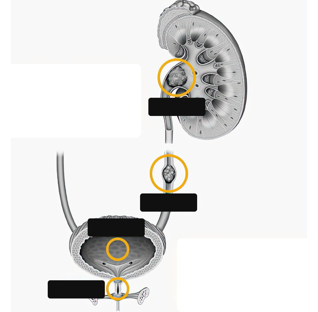 Kidney and ureteral stones – over 90% of urinary stones, in the upper urinary tract. / Bladder and urethral stones – under 10%, in the lower urinary tract.