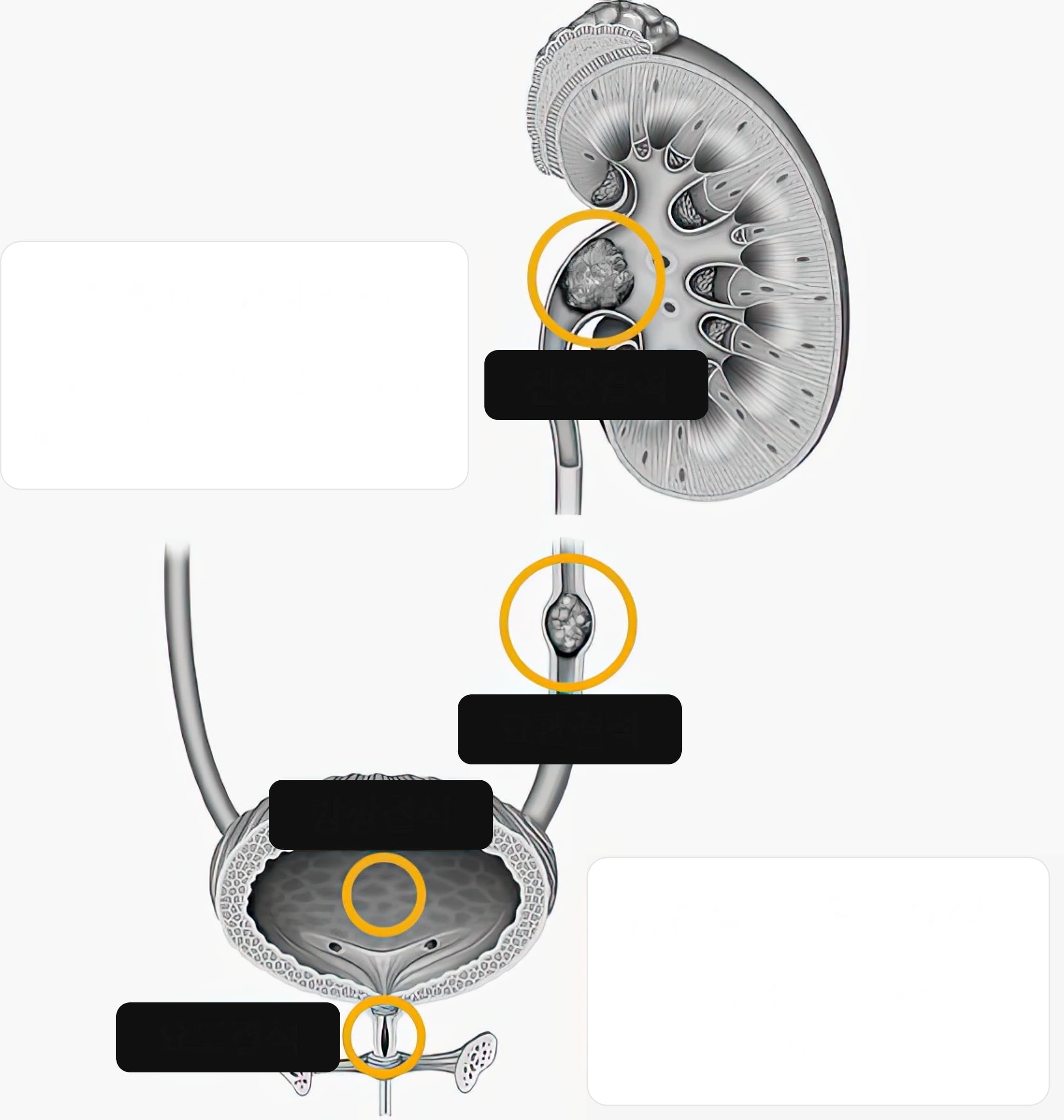 Kidney and ureteral stones – over 90% of urinary stones, in the upper urinary tract. / Bladder and urethral stones – under 10%, in the lower urinary tract.