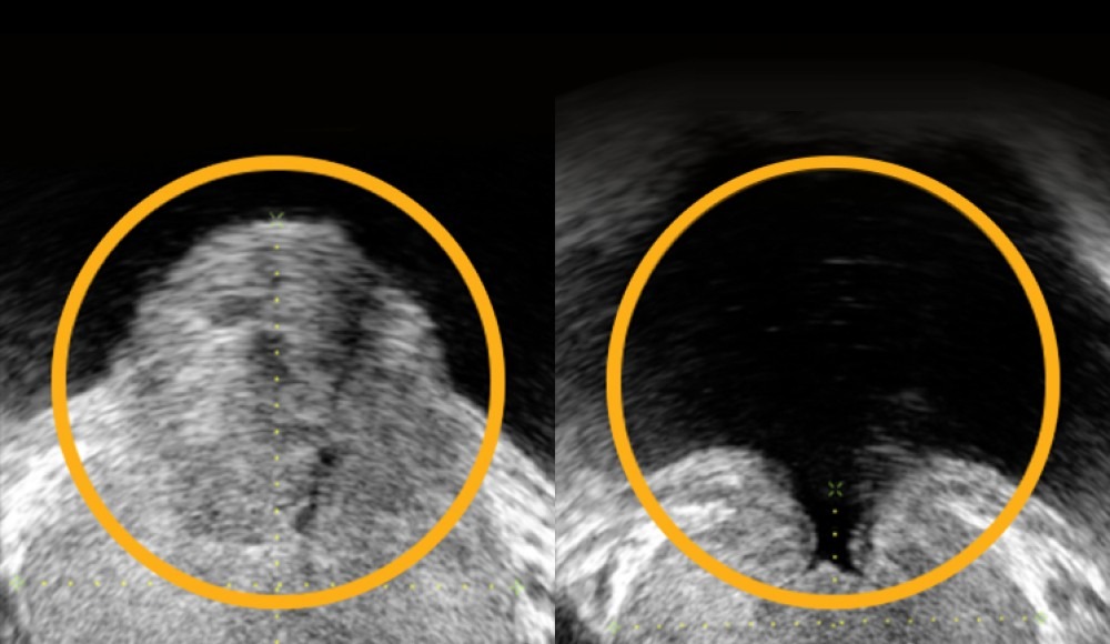 Comparison of a normal prostate and an enlarged prostate