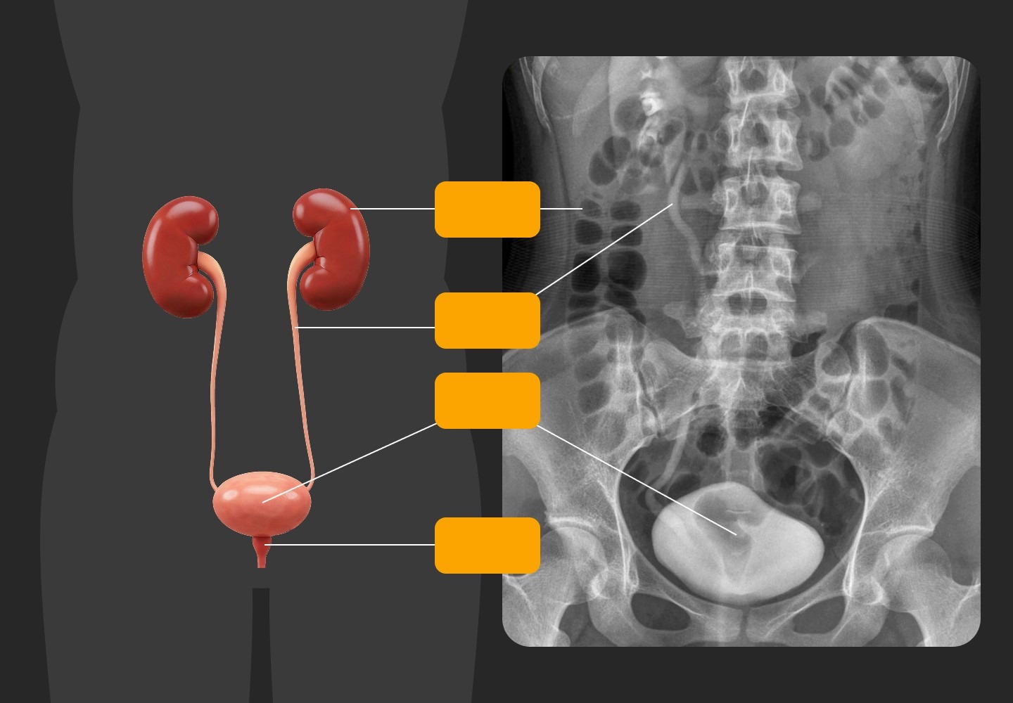 Illustration of kidneys, ureters, bladder, and urethra with a KUB X-ray