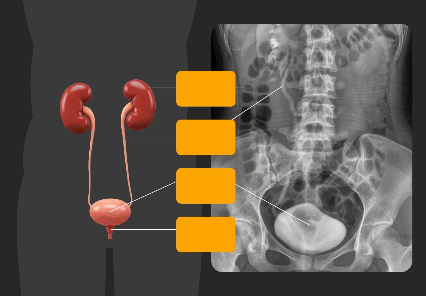 Illustration of kidneys, ureters, bladder, and urethra with a KUB X-ray