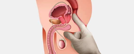 환자의 항문을 통해 전립선을 만져 보며 상태를 확인하는 검사