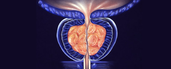전립선암의 조기 진단에 이용
