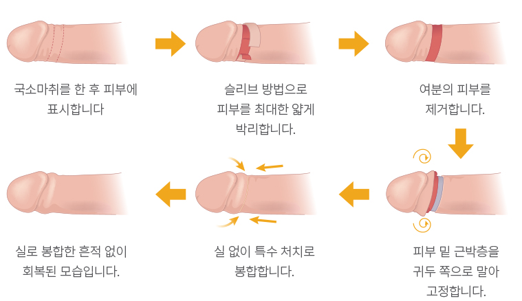 레이저로 포피를 제거하는 수술