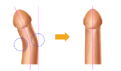 휘어지는 방향의 반대편 백막을 절제하고 봉합