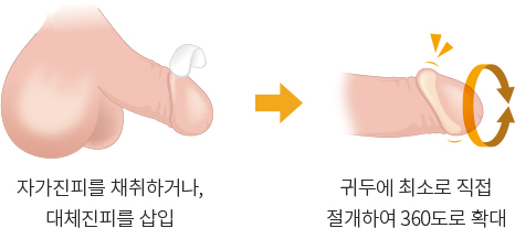 귀두에 최소로 직접 절개