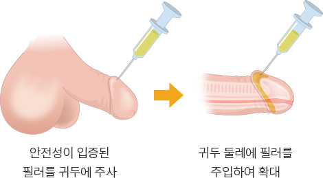 귀두 둘레에 필러를 주입하여 확대