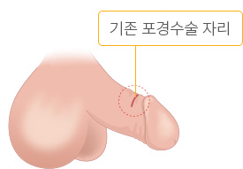 기존 포경수술 자리를 1.5~2cm 절개