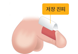 절개된 부위 안쪽을 미세하게 박리하여 저장진피를 이식