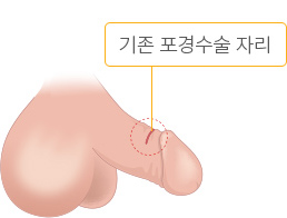 기존 포경수술 자리를 1.5~2cm 절개