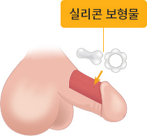 실리콘 보형물 준비