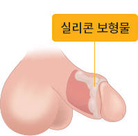 실리콘 보형물 삽입