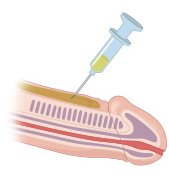 음경의 근막층에 전체적으로 주입