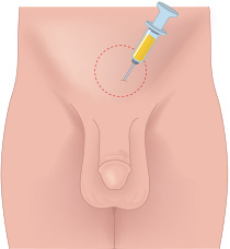 지방이 많은 하복부에서 지방 채취