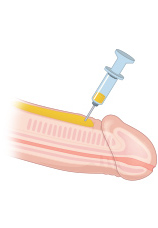 채취한 순수 지방을 음경해면체 주위에 주입