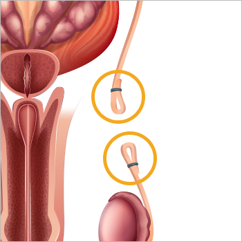 무도정관수술은 칼로 음낭의 피부를 절개하지 않고 수술하는 것이 특징