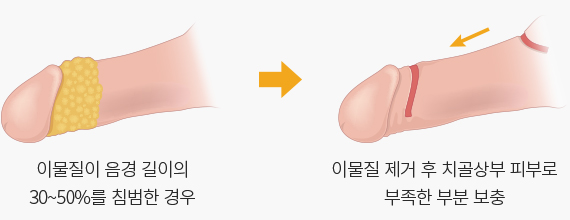 피부 괴사가 진행 중인 경우에 고려하는 수술법