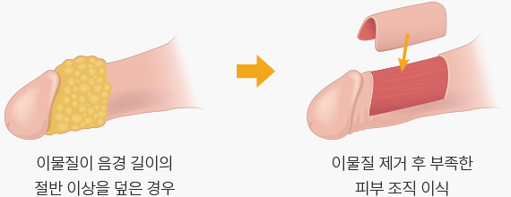 엉덩이나 허벅지 피부를 이식하여 부족한 피부를 보충