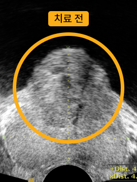 전립선 비대증 치료 전