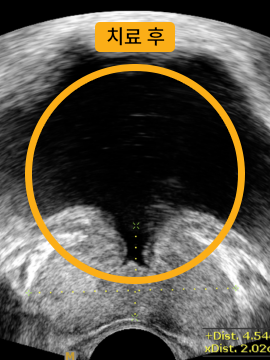 전립선 비대증 치료 후