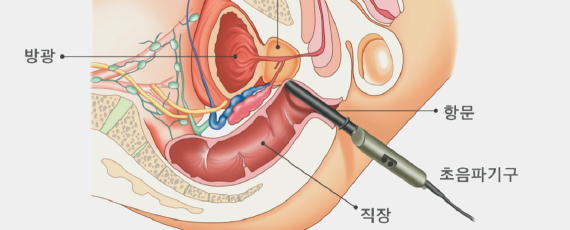 경직장 전립선 초음파 검사