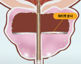 로봇으로 제어되는 비가열 워터젯을 통해 해당 부위 절제