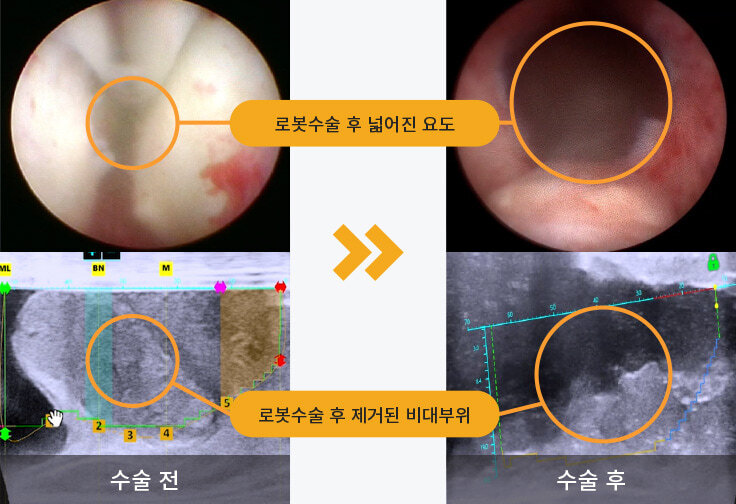 로봇수술 후 넓어진 요도, 로봇수술 후 제거된 비대부위