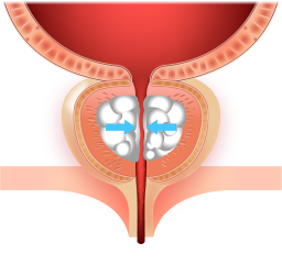 비대해진 전립선 조직