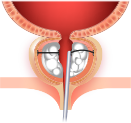 전립선 임플란트로 고정