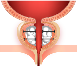 요도 입구가 확보된 전립선