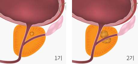 1기 , 2기 전립선 암